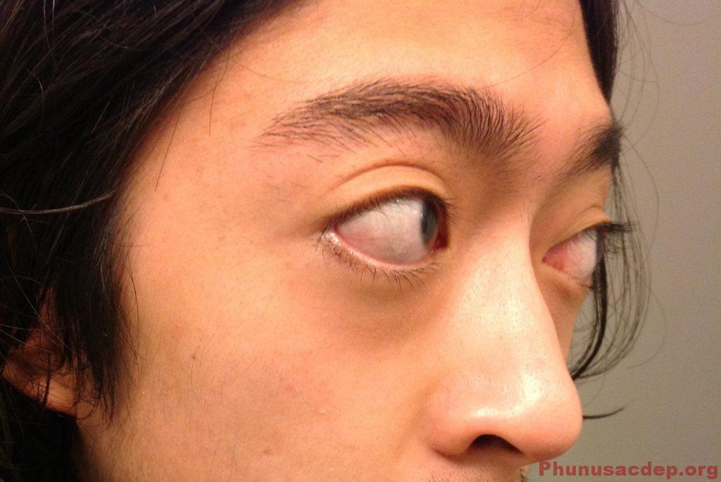 Cách chữa trị mắt lồi hiệu quả