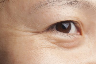 Tình trạng mắt nhiều da trùng hay gặp